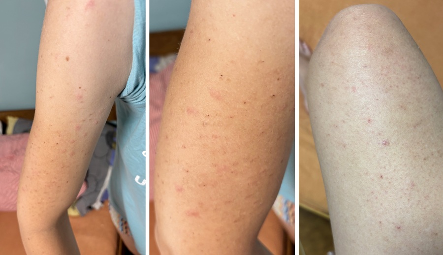 banánový balzám Medarek - účinky před a po na keratosis pilaris