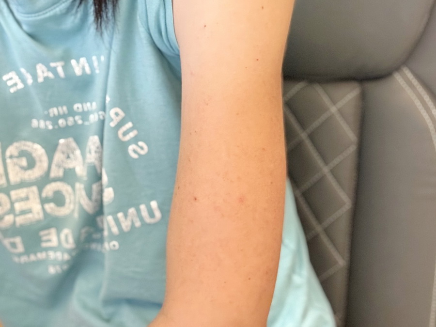 banánový balzám Medarek - účinky před a po